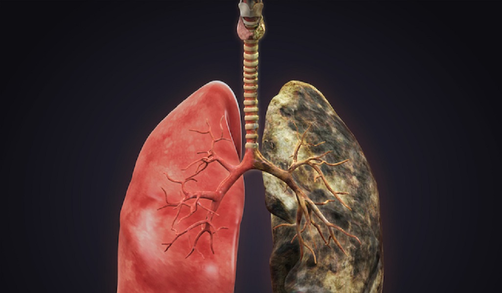 Lung Surgery Specialist in Hyderabad