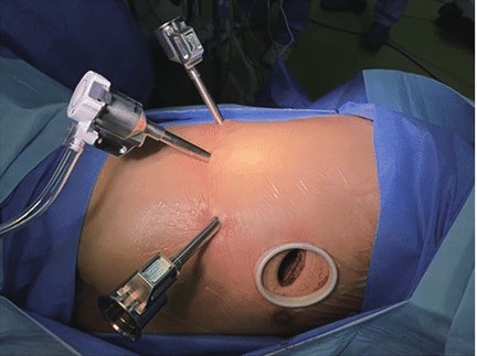 VATS (Video-Assisted Thoracoscopic Surgery)