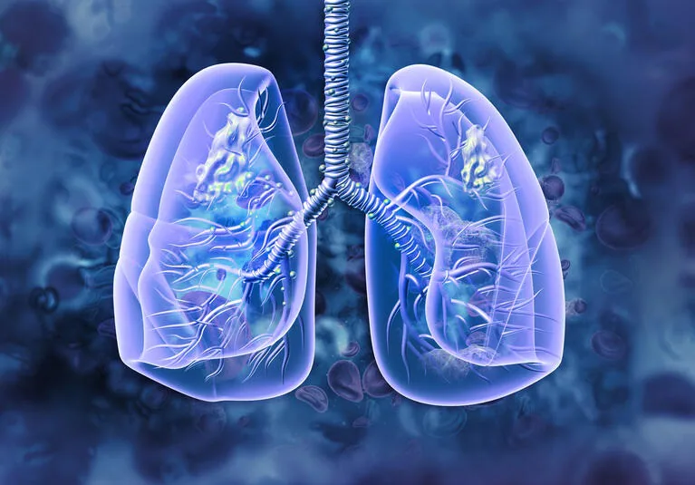 Lung Transplant in Hyderabad