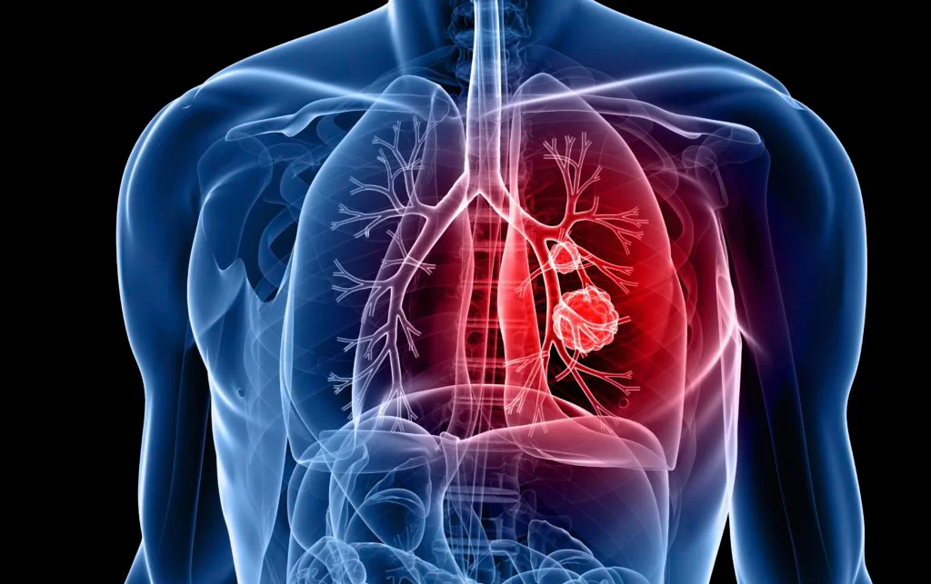 Thoracic Surgery in Hyderabad